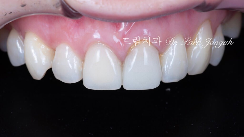 라미네이트 재시술 올세라믹 재시술 앞니 재시술
