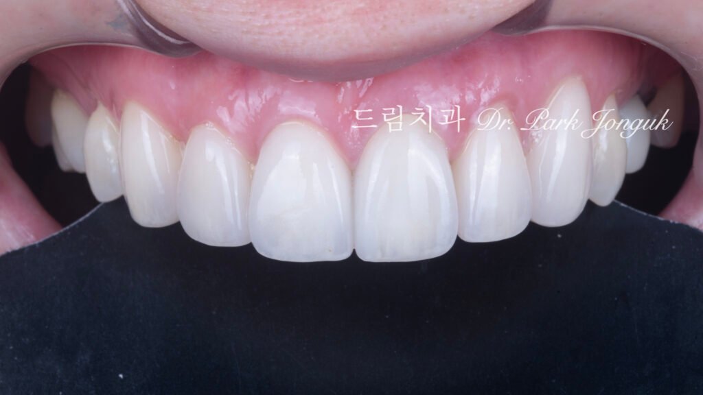 라미네이트 재시술 올세라믹 재시술 앞니 재시술