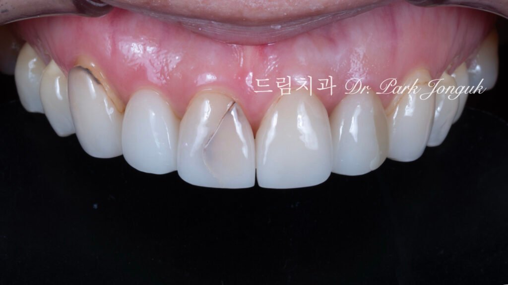 라미네이트 재시술 올세라믹 재시술 앞니 재시술