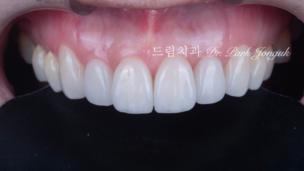 라미네이트 재시술 올세라믹 재시술 앞니 재시술