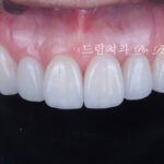 라미네이트 재시술 올세라믹 재시술 앞니 재시술