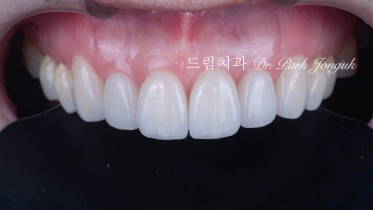 라미네이트 재시술 올세라믹 재시술 앞니 재시술