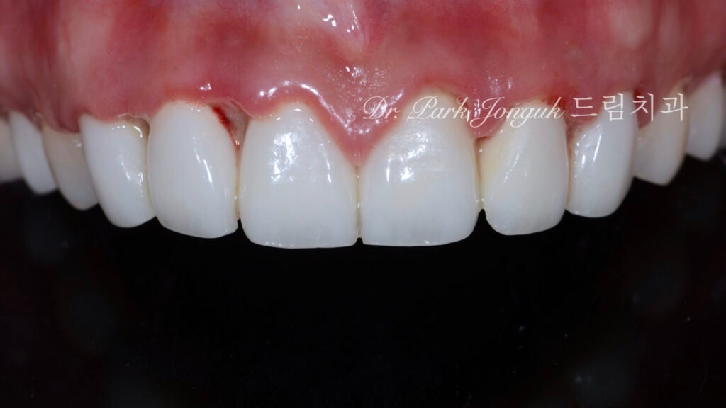 라미네이트 부작용 잇몸염증 재시술