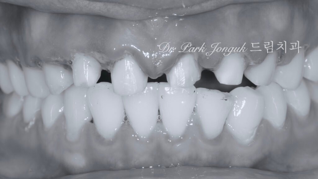 라미네이트 부작용 잇몸염증 재시술