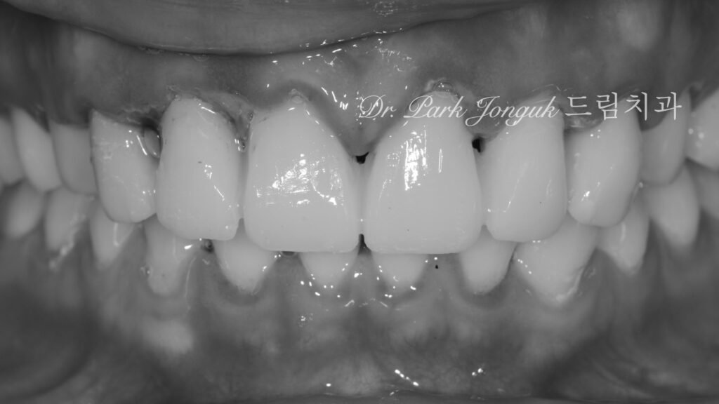 라미네이트 부작용 잇몸염증 재시술