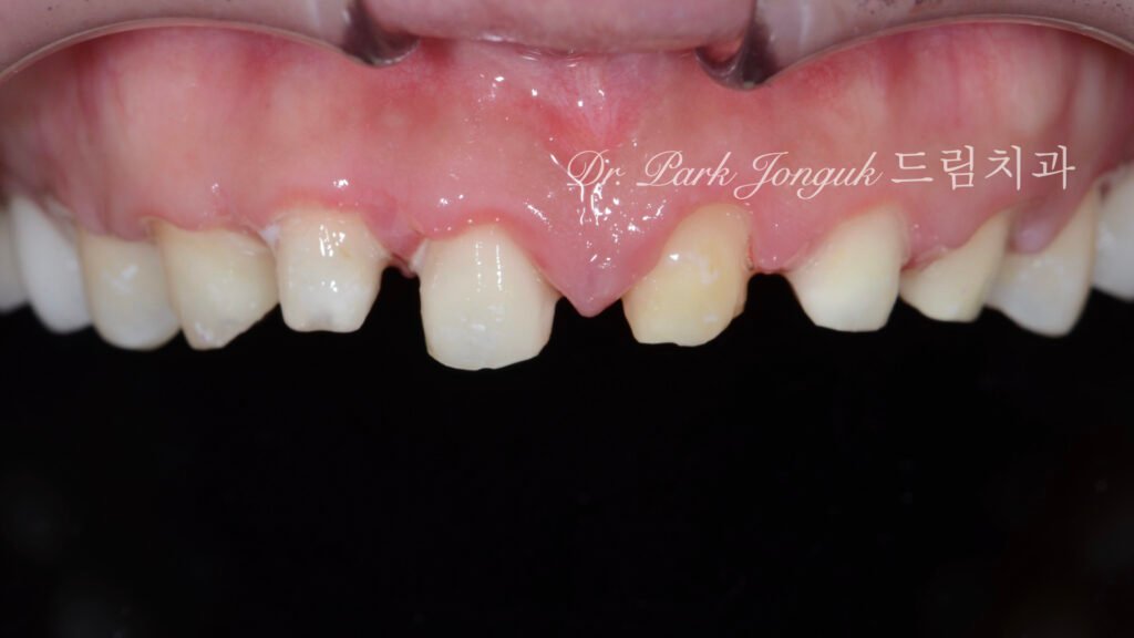 라미네이트 부작용 잇몸염증 재시술