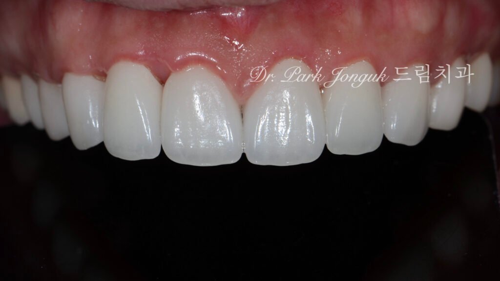 라미네이트 부작용 잇몸염증 재시술