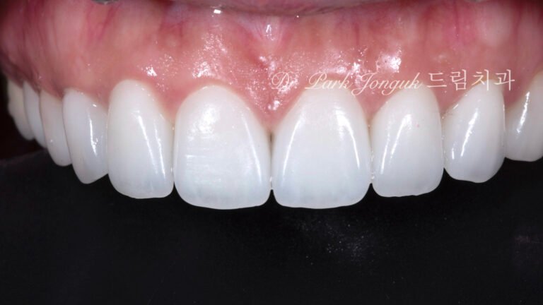 라미네이트 부작용 잇몸염증 재시술