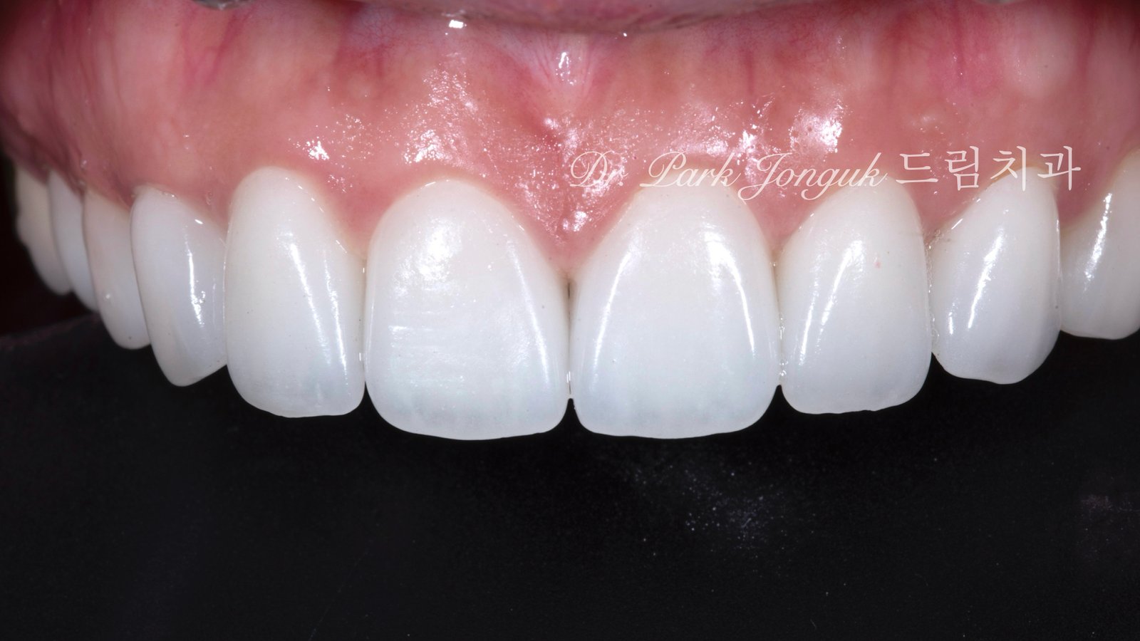 라미네이트 부작용 잇몸염증 재시술