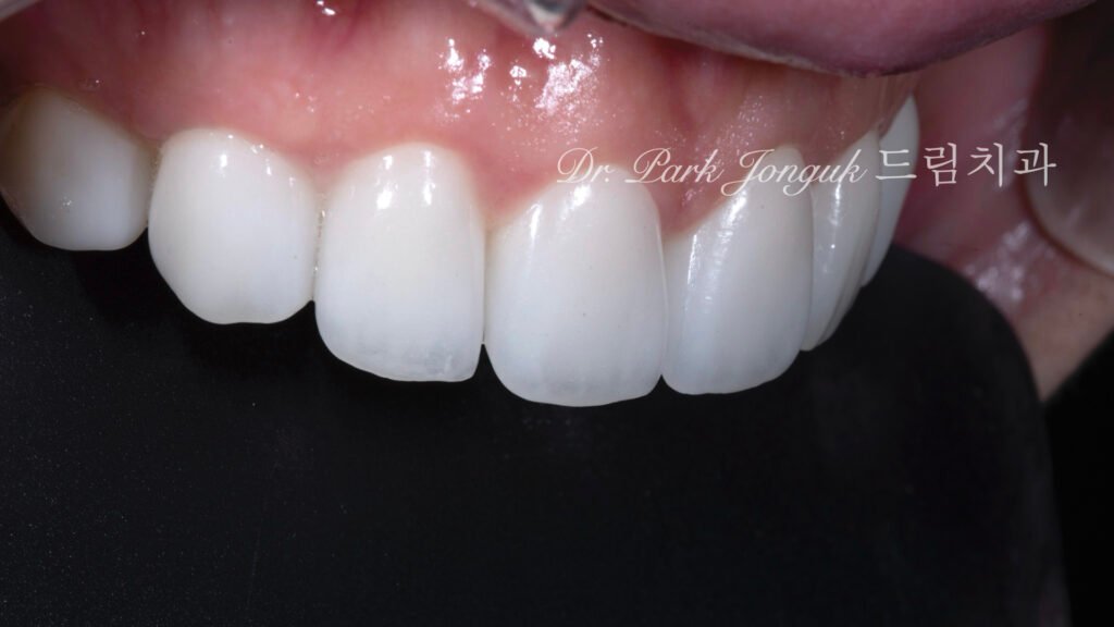 라미네이트 부작용 잇몸염증 재시술