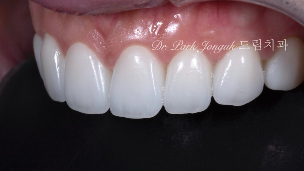 라미네이트 부작용 잇몸염증 재시술