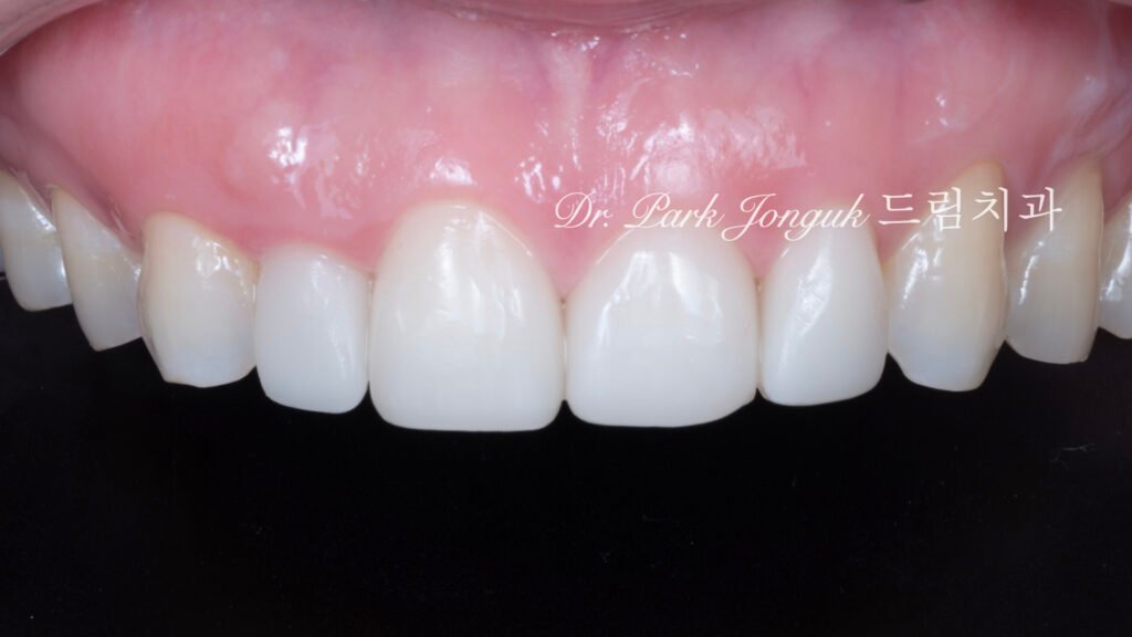 라미네이트 재시술