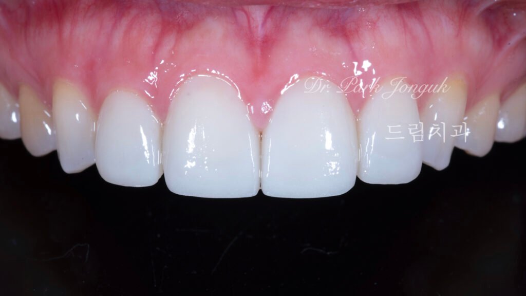 라미네이트 재시술