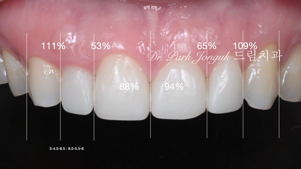라미네이트 재시술
