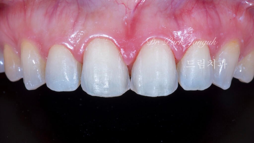 라미네이트 재시술