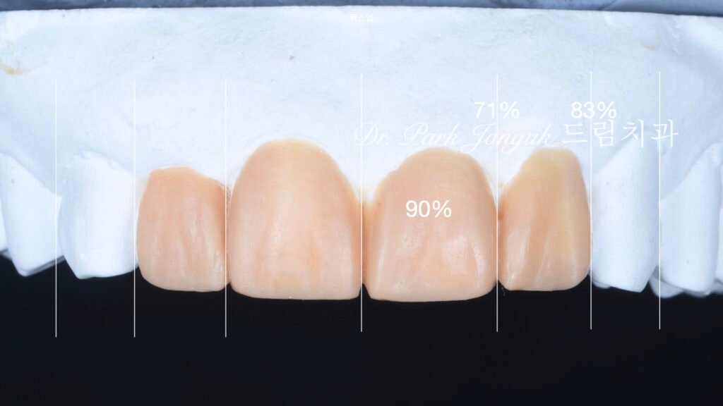 라미네이트 재시술