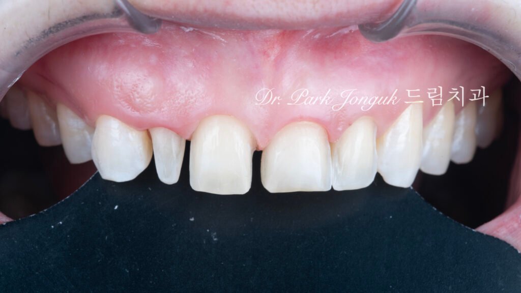 라미네이트 재시술