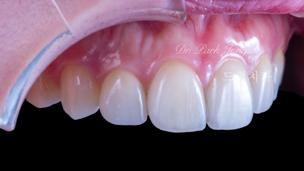 라미네이트 재시술