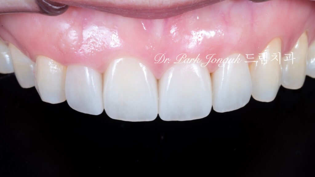 라미네이트 재시술