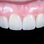 라미네이트 재시술