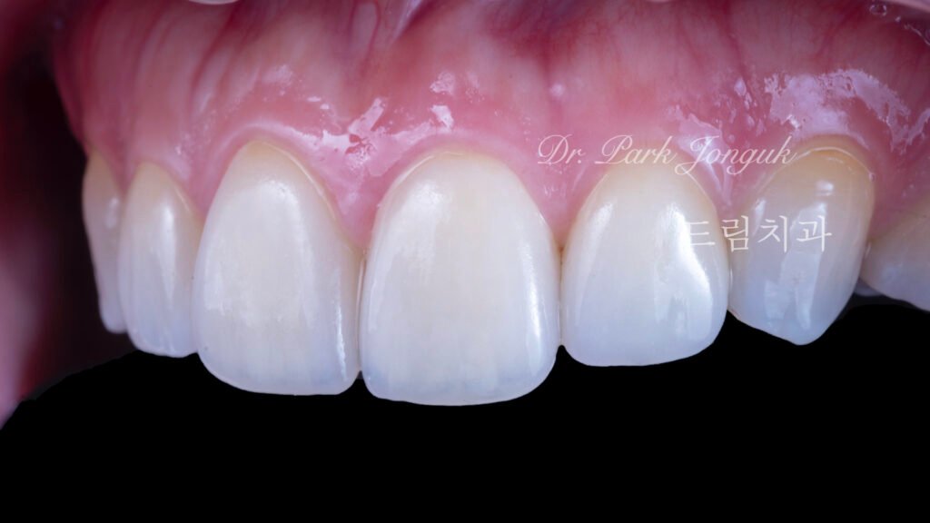 라미네이트 재시술