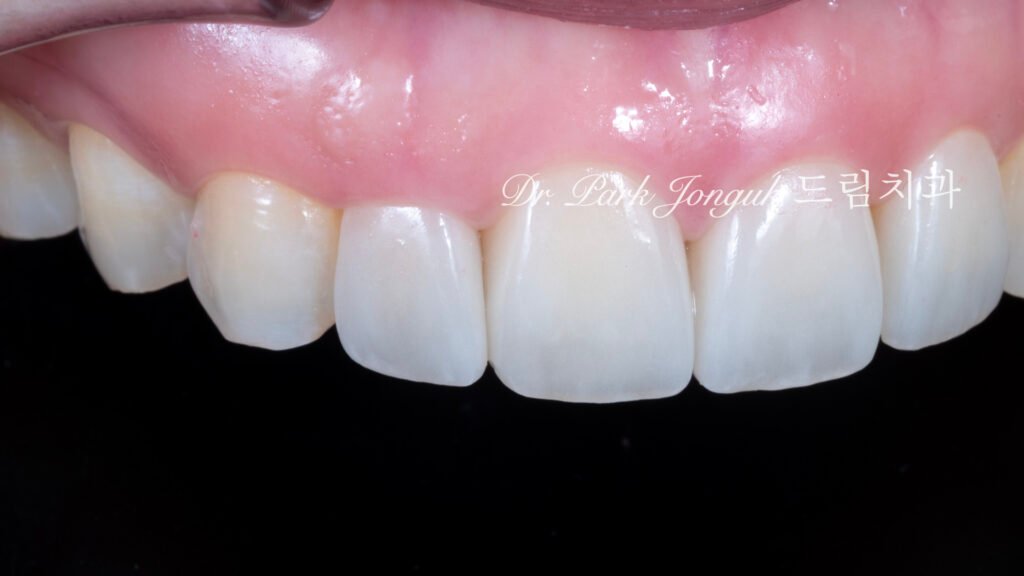 라미네이트 재시술