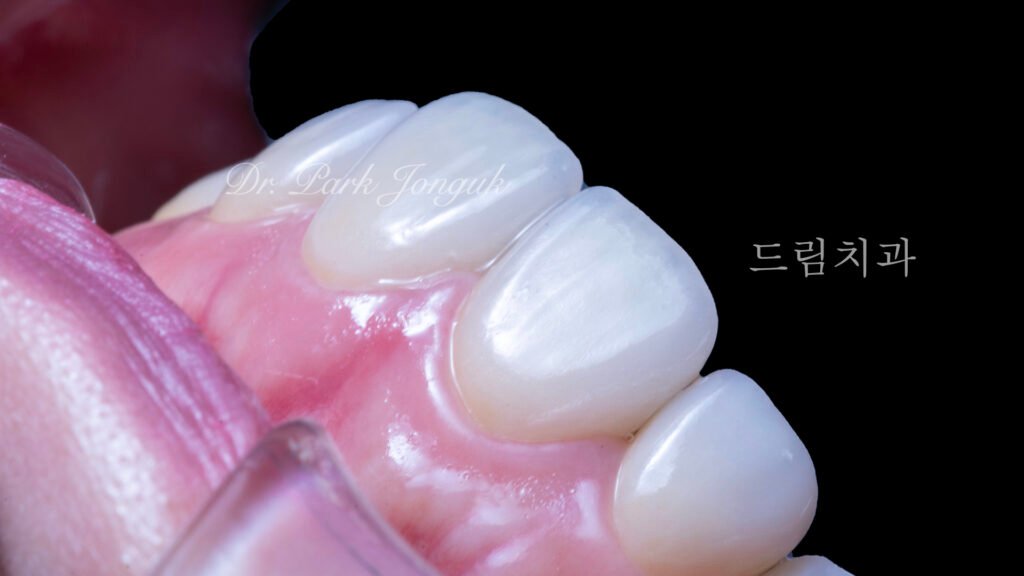 라미네이트 재시술