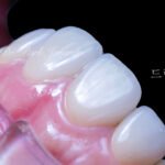 라미네이트 재시술