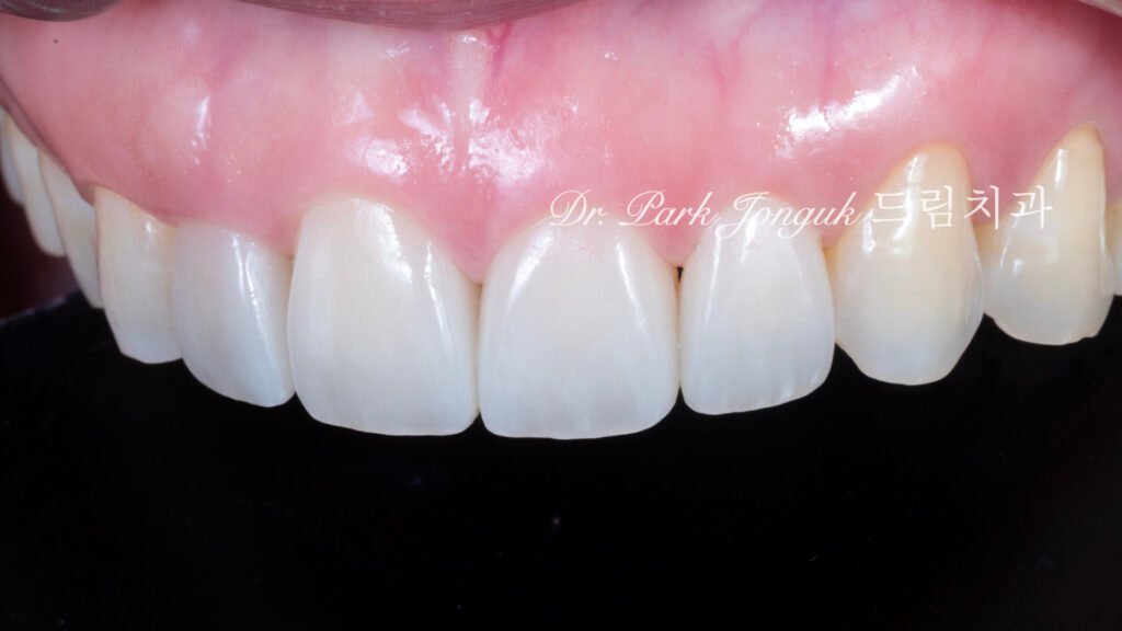 라미네이트 재시술