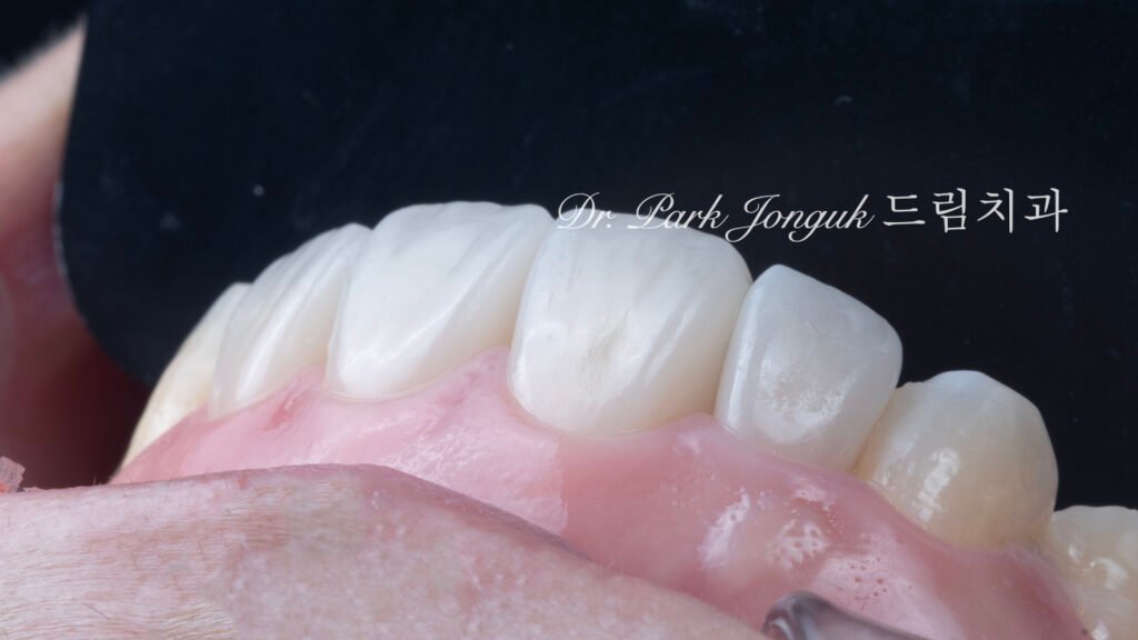 라미네이트 재시술