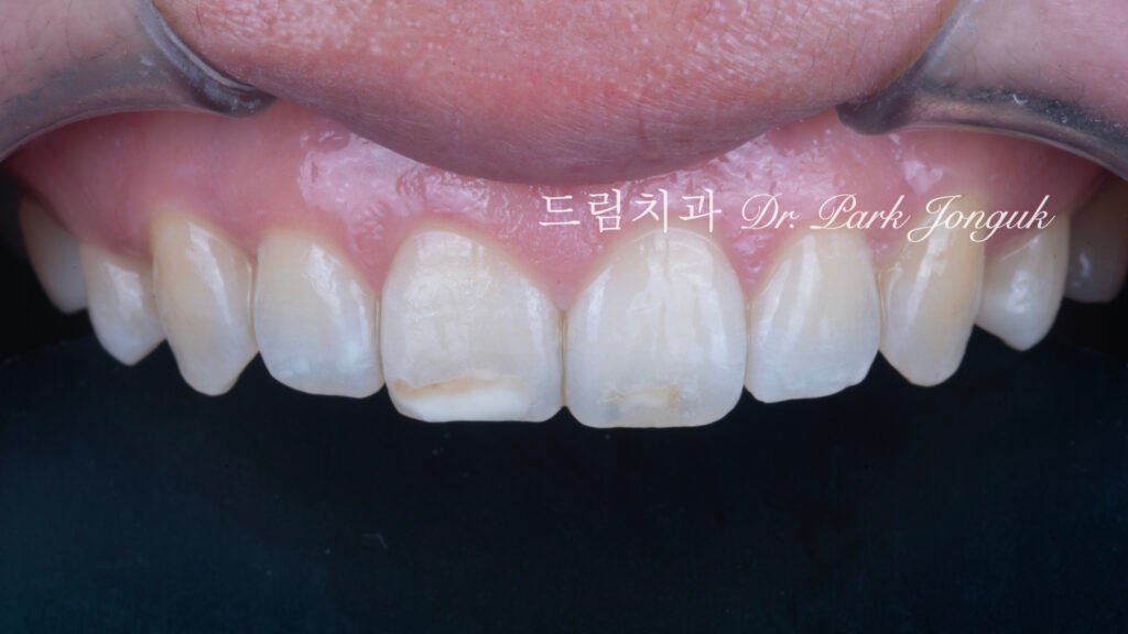 무삭제 라미네이트