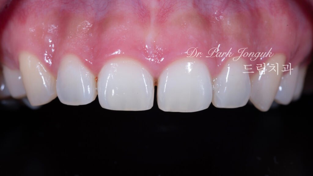 무삭제 라미네이트, No-Prep Laminate, 옥니, Retroclined Teeth, 왜소치, Microdontia, 정중이개, Midline Diastema, 치은 성형, Gingivectomy, 최소 침습, Minimally Invasive