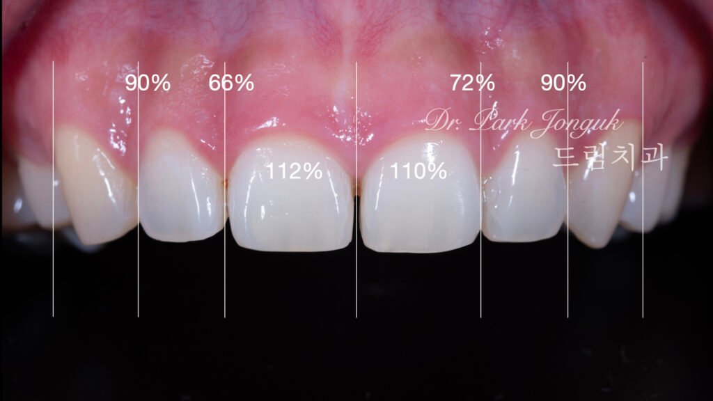 무삭제 라미네이트, No-Prep Laminate, 옥니, Retroclined Teeth, 왜소치, Microdontia, 정중이개, Midline Diastema, 치은 성형, Gingivectomy, 최소 침습, Minimally Invasive