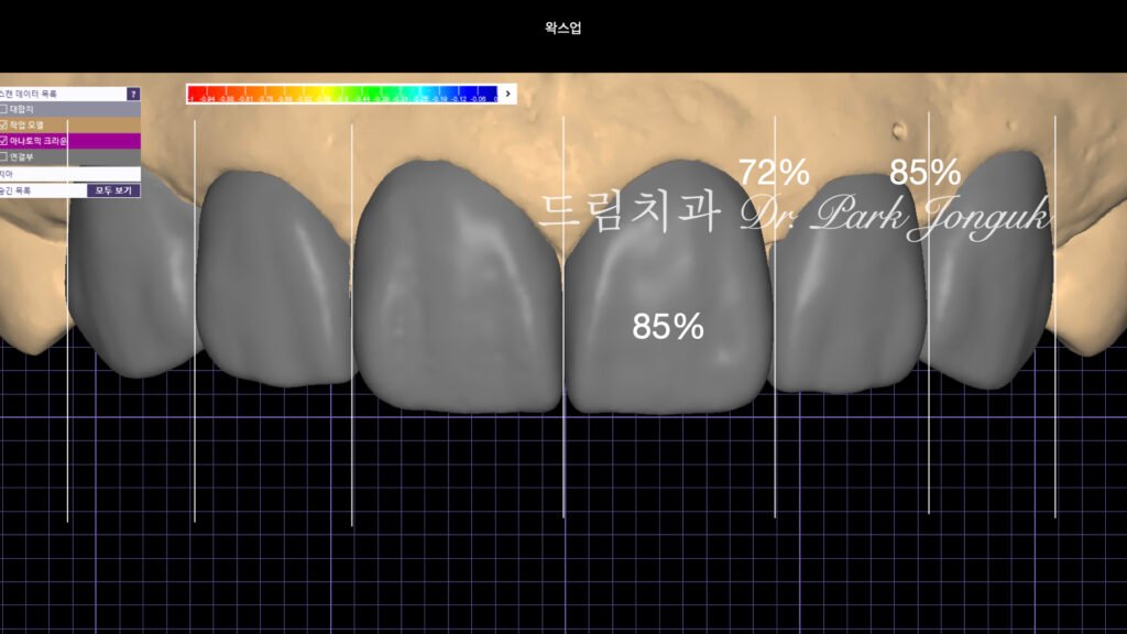 무삭제 라미네이트