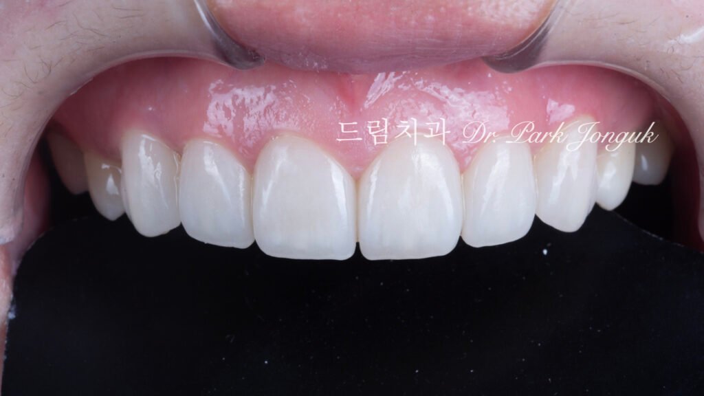 무삭제 라미네이트