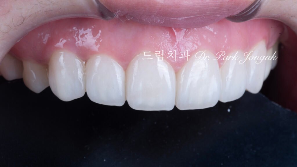 무삭제 라미네이트