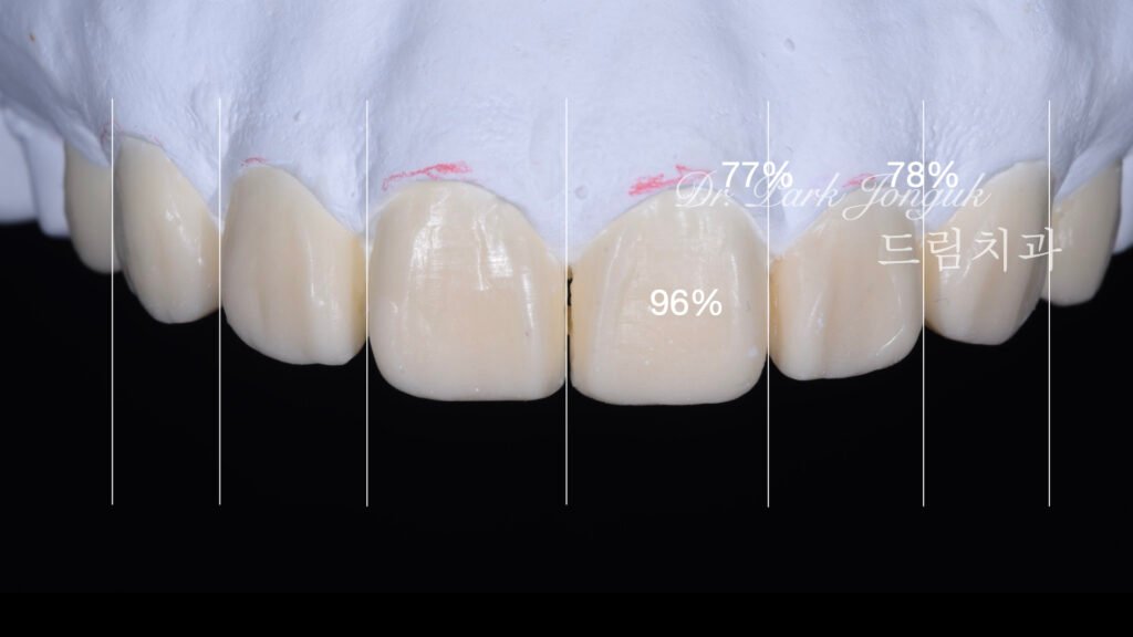 무삭제 라미네이트, No-Prep Laminate, 옥니, Retroclined Teeth, 왜소치, Microdontia, 정중이개, Midline Diastema, 치은 성형, Gingivectomy, 최소 침습, Minimally Invasive