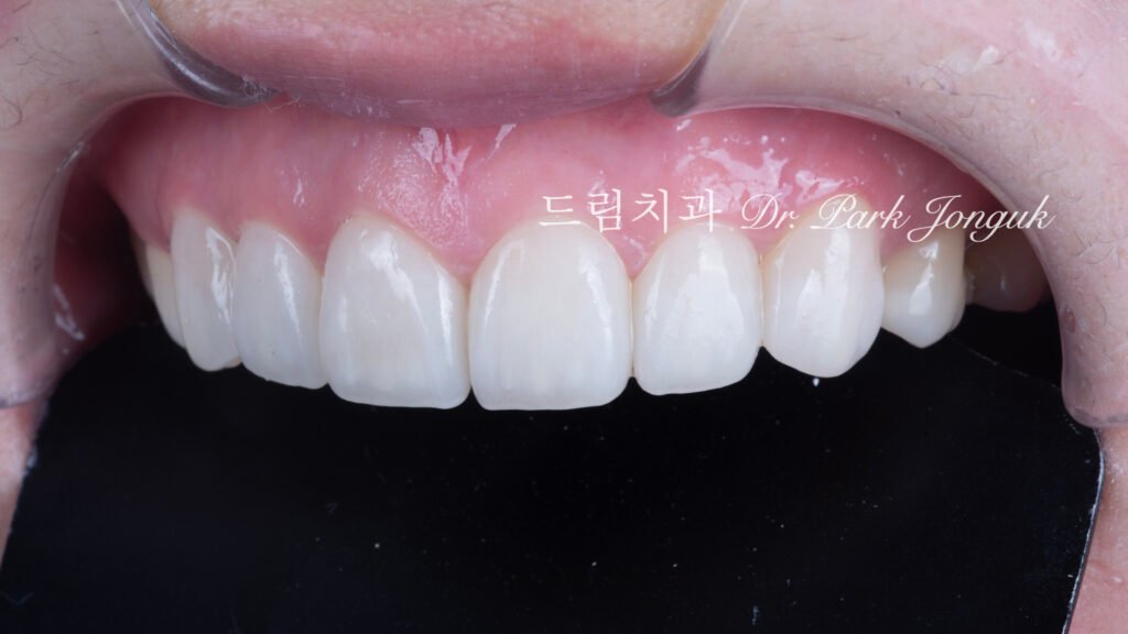 무삭제 라미네이트