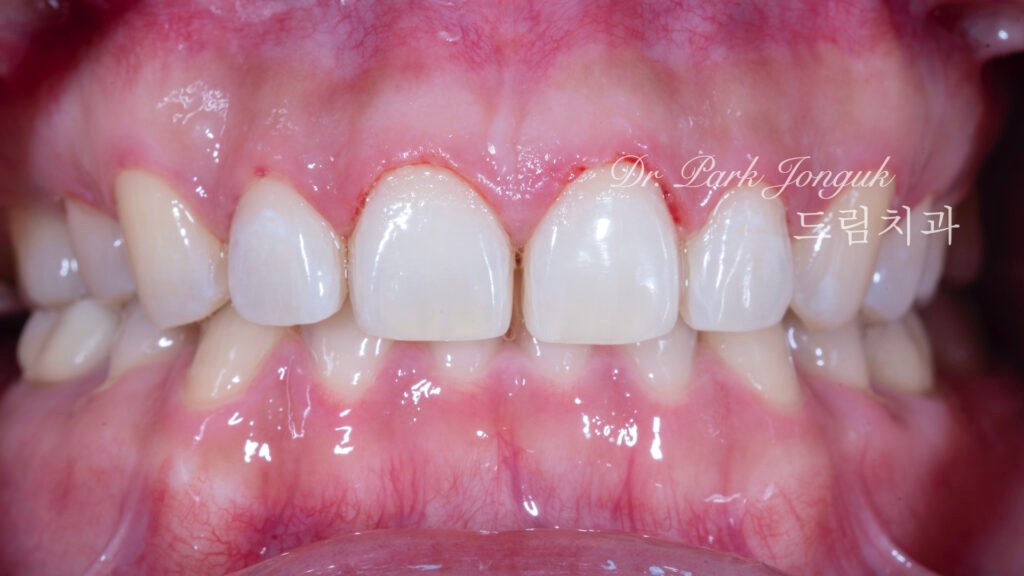 무삭제 라미네이트, No-Prep Laminate, 옥니, Retroclined Teeth, 왜소치, Microdontia, 정중이개, Midline Diastema, 치은 성형, Gingivectomy, 최소 침습, Minimally Invasive