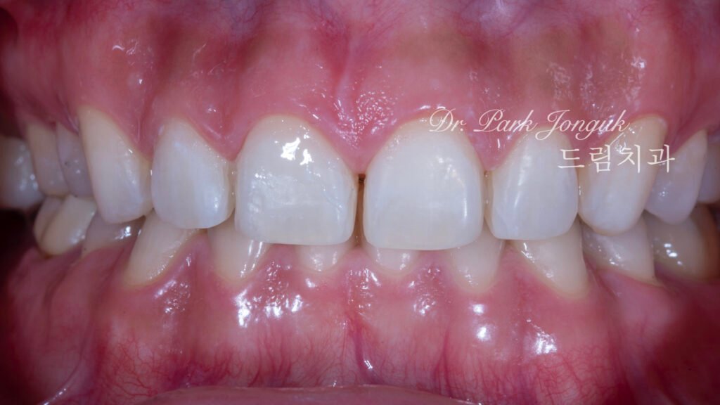 무삭제 라미네이트, No-Prep Laminate, 옥니, Retroclined Teeth, 왜소치, Microdontia, 정중이개, Midline Diastema, 치은 성형, Gingivectomy, 최소 침습, Minimally Invasive