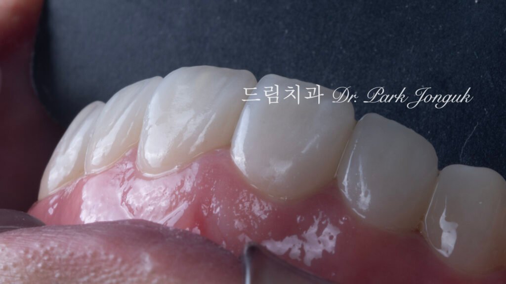 무삭제 라미네이트