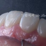 무삭제 라미네이트