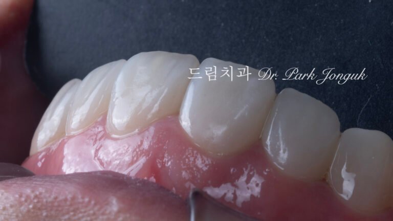 무삭제 라미네이트