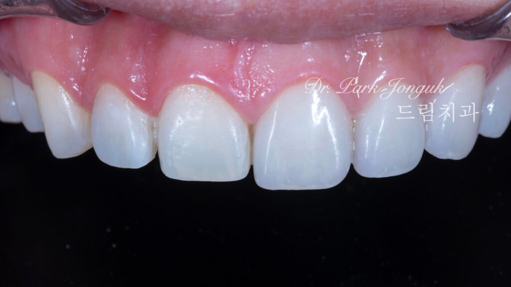 무삭제 라미네이트, No-Prep Laminate, 옥니, Retroclined Teeth, 왜소치, Microdontia, 정중이개, Midline Diastema, 치은 성형, Gingivectomy, 최소 침습, Minimally Invasive