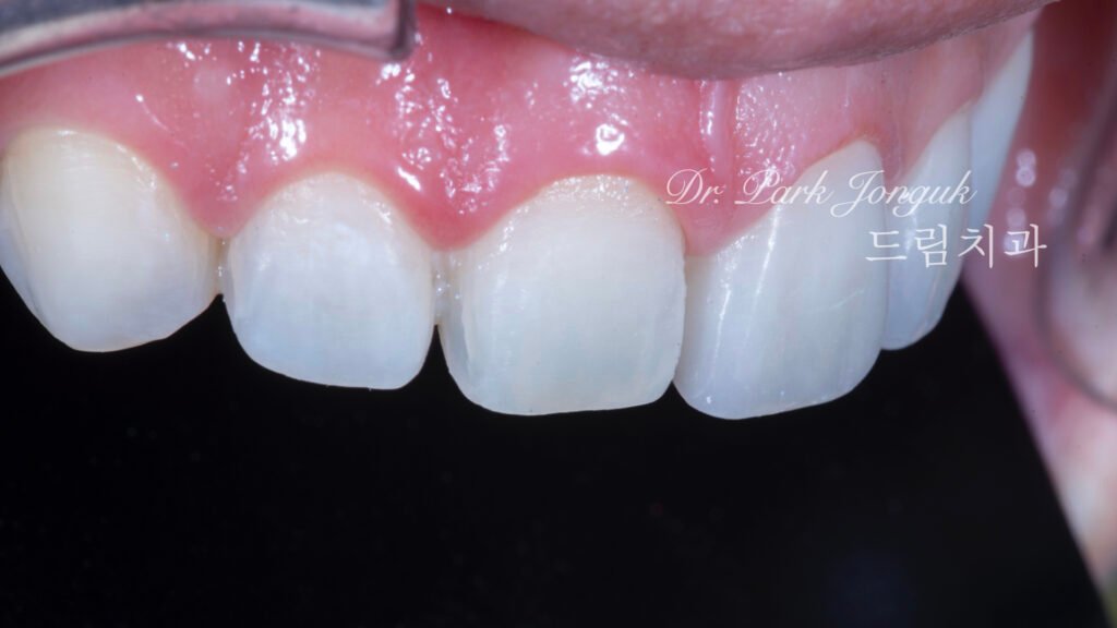 무삭제 라미네이트, No-Prep Laminate, 옥니, Retroclined Teeth, 왜소치, Microdontia, 정중이개, Midline Diastema, 치은 성형, Gingivectomy, 최소 침습, Minimally Invasive