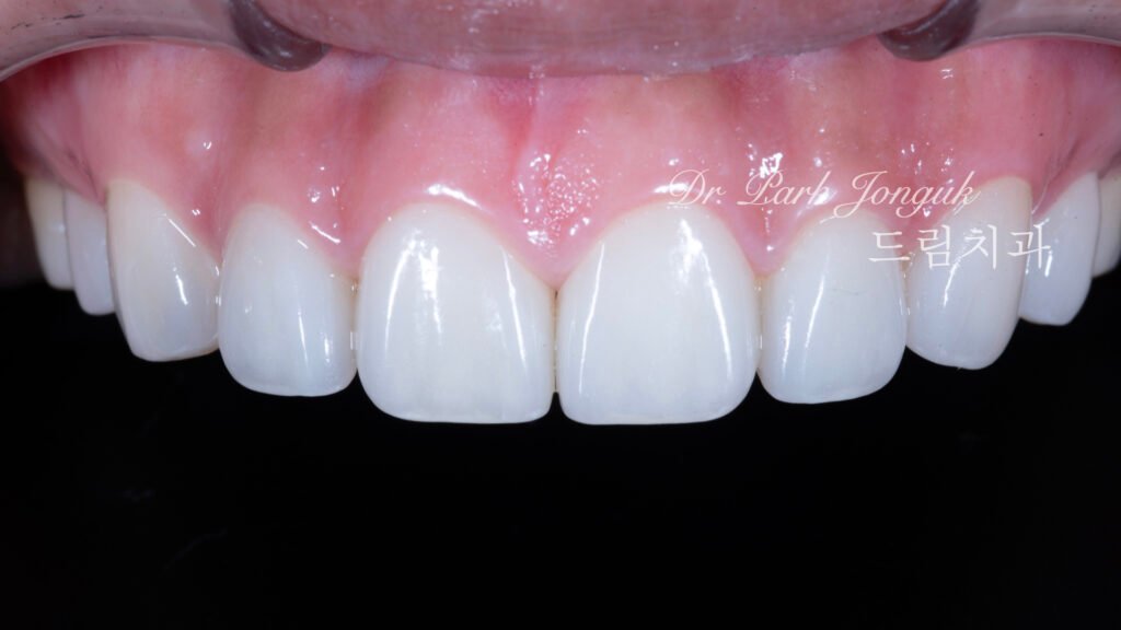 무삭제 라미네이트, No-Prep Laminate, 옥니, Retroclined Teeth, 왜소치, Microdontia, 정중이개, Midline Diastema, 치은 성형, Gingivectomy, 최소 침습, Minimally Invasive