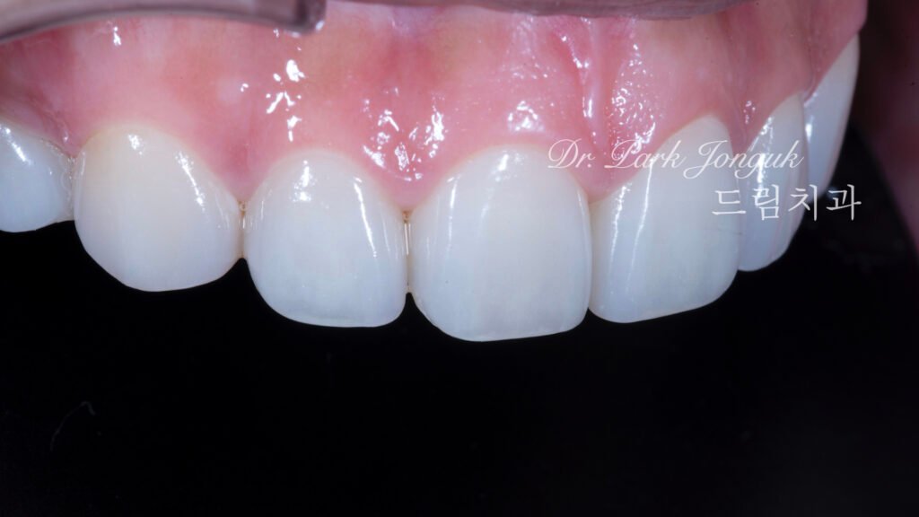 무삭제 라미네이트, No-Prep Laminate, 옥니, Retroclined Teeth, 왜소치, Microdontia, 정중이개, Midline Diastema, 치은 성형, Gingivectomy, 최소 침습, Minimally Invasive