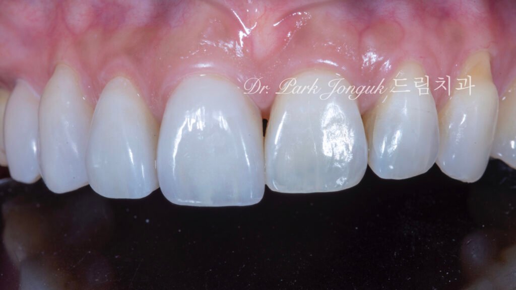 교정후 블랙트라이앵글 무삭제 라미네이트 치료