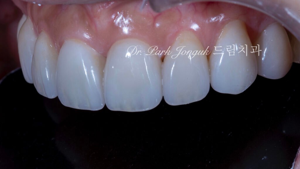교정후 블랙트라이앵글 무삭제 라미네이트 치료