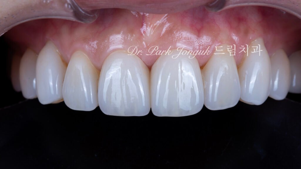 교정후 블랙트라이앵글 무삭제 라미네이트 치료